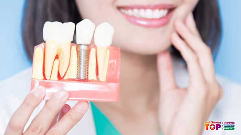 Trong-rang-implant-hai-duong